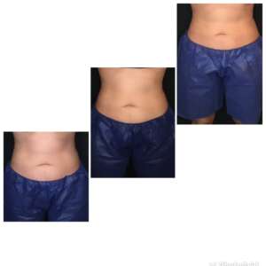 Abs Before & After Coolsculpt Treatment