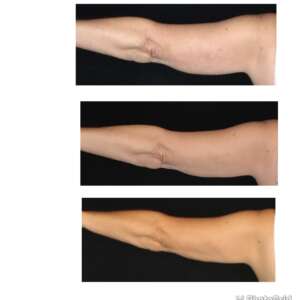 Arm Before & After Coolsculpt Treatment