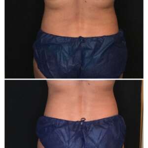 Flanks Before & After One Coolsculpt Treatment