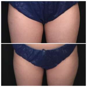 Thighs Before & After Coolsculpt Treatment